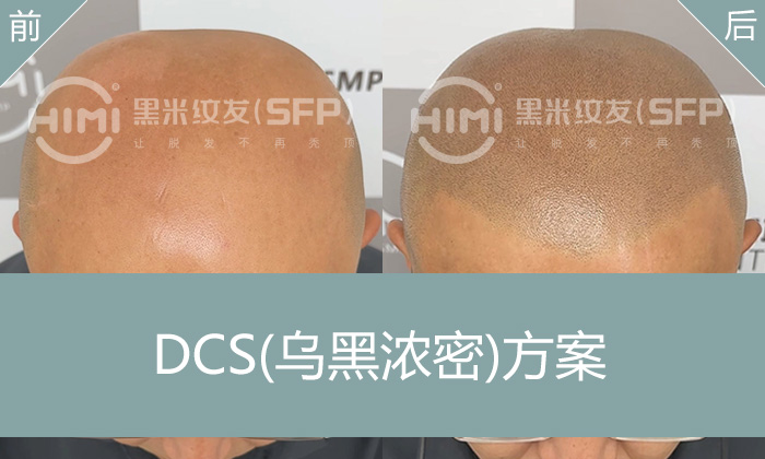 北京武先生光头纹发真实对比｜浓密寸头效果惊艳