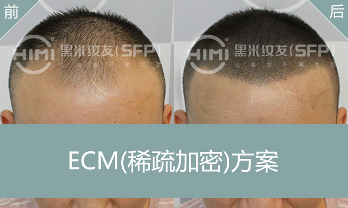 广州陈先生的纹发加密之旅：告别发际线后移与头顶稀疏