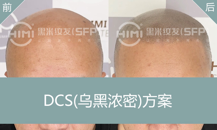 广州黄先生脱发光头逆袭！黑米纹发几小时变身清爽寸头