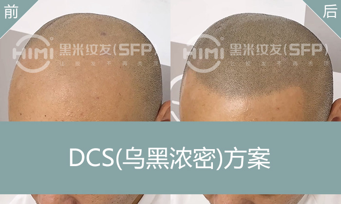 发际线后移严重、头顶稀疏？北京刘先生纹发后年轻十岁