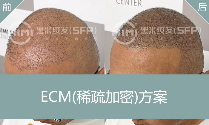 发际线后移怎么办？北京郝先生纹发清爽寸头