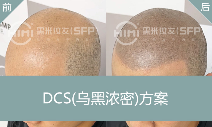 北京葛先生十年脱发困扰？纹发变寸头，光头轻松换新颜