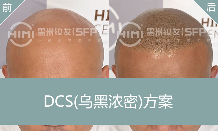 植发失败留疤光头？广州张先生15年脱发逆袭