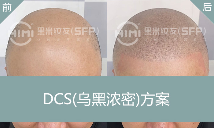 遗传性脱发自救指南 | 秃头变寸头黑科技，5小时重塑形象