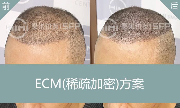 武汉严先生8年脱发头顶稀疏严重？纹发加密真实效果揭秘