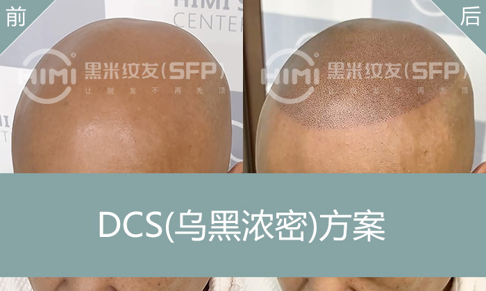 武汉黄先生20年脱发困扰？光头纹发打造自然郭德纲发型