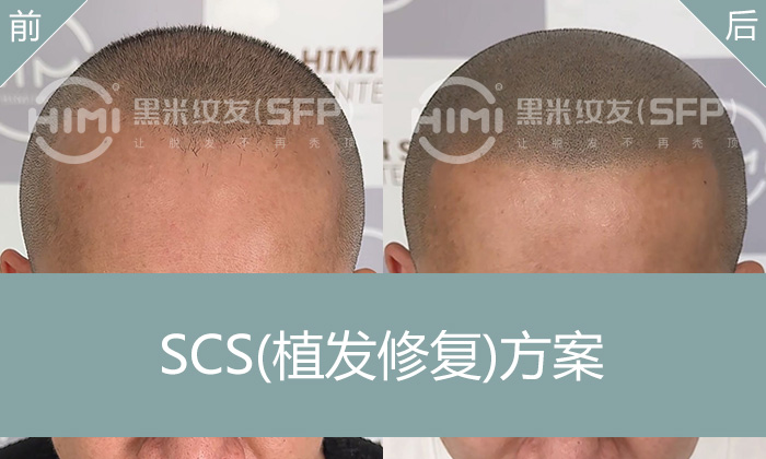 关先生头发稀疏又植发失败？纹发变浓密寸头