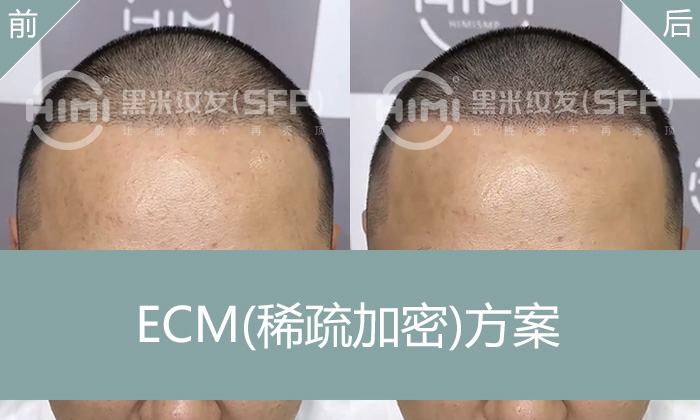 头顶严重稀疏8年？管先生亲测纹发加密解决遗传性脱发困扰