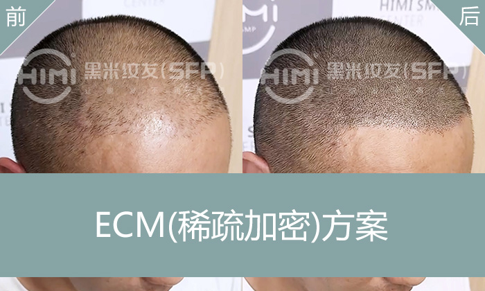 严重头发稀疏救星，纹发加密终结王先生遗传性脱发