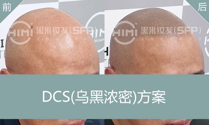 石先生脱发10年纹发秒变浓密寸头，不用生发也能告别光头