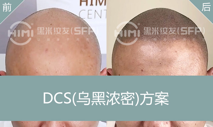 头顶脱发变秃？罗先生10年秃顶靠纹发逆袭浓密寸头