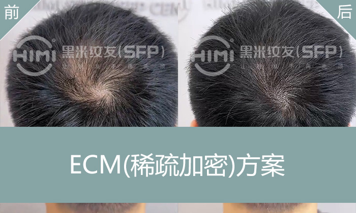 发旋头发稀疏怎么办？1小时纹发加密解决翟先生脱发困扰