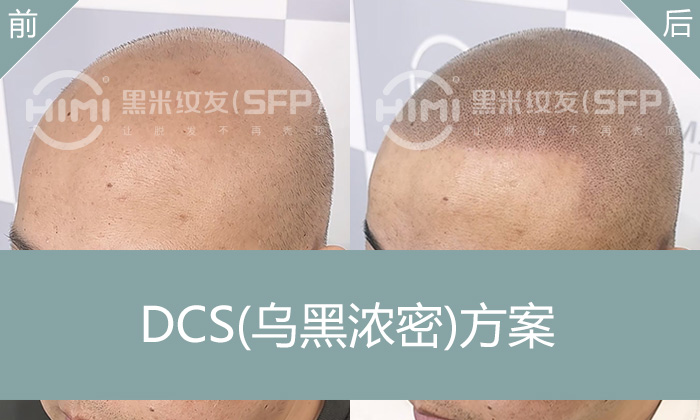 邹先生5年雄脱亲述：告别米诺地尔无效，纹发后重获自信