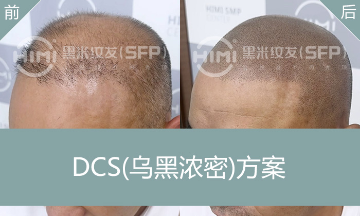 植发失败后头发稀疏？看田先生通过纹发摆脱脱发困扰