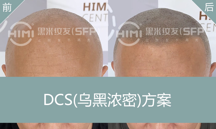 广州杨先生的发际线困扰解决方案 | 遗传性脱发10年纹发真实案例