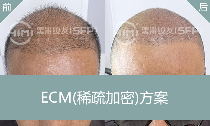 植发失败别慌！武汉张先生头发稀疏，纹发寸头助其重拾自信