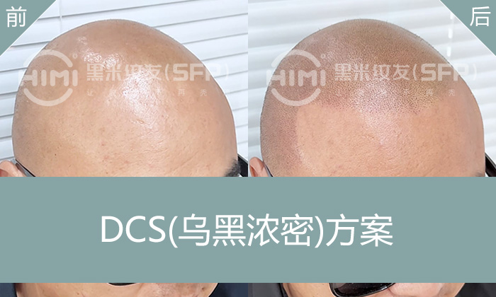 武汉陈先生真实案例 | 秃顶十年终选纹发变浓密寸头