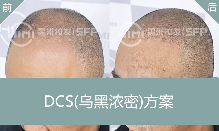 武汉纹发案例：杨先生10年脱发史，发际线高+头顶稀疏