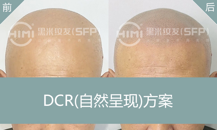 沈阳秃头纹发-10年遗传脱发真实案例-冯先生纹发蜕变记