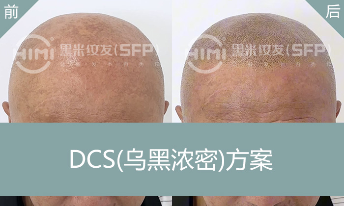 重庆秃顶纹发-15年脂溢性脱发赵先生的自然解决方案