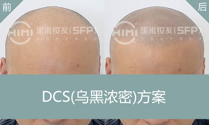 重庆纹发拯救郭先生发际线后移｜寸头造型解决方案
