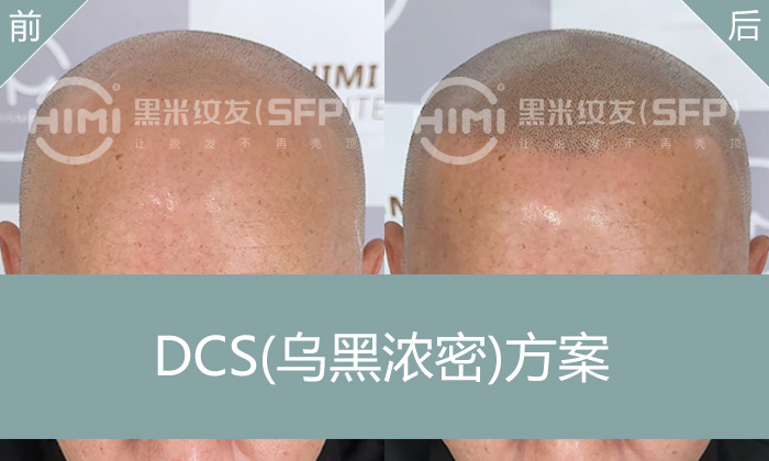 广州李先生遗传性脱发修复：黑米纹发加密解决发际线后移 + 头顶稀疏