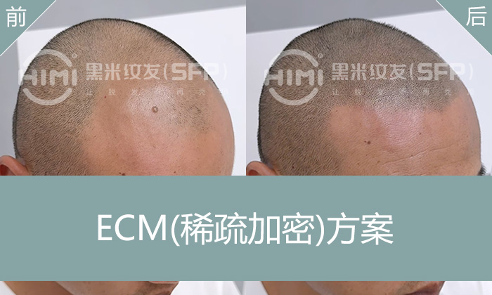 重庆谢先生10年脱发修复：黑米纹发加密补全M型发际线+改善头顶稀疏