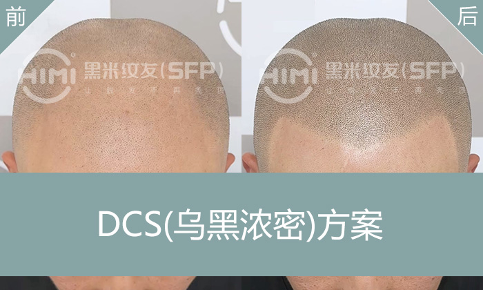 北京郭先生遗传性脱发救星！黑米纹发M型后移变浓密寸头