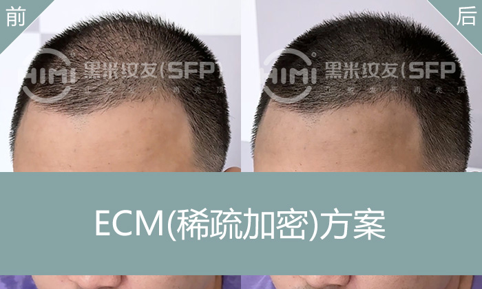 遗传性脱发怎么办？广州苏先生通过黑米纹发加密让头顶变浓密