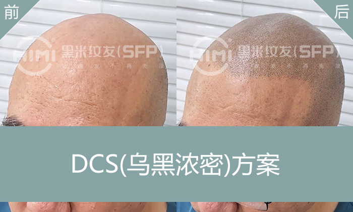 多年脱发光秃怎么办？看武汉刘先生如何靠纹发逆袭-黑米纹发成功案例