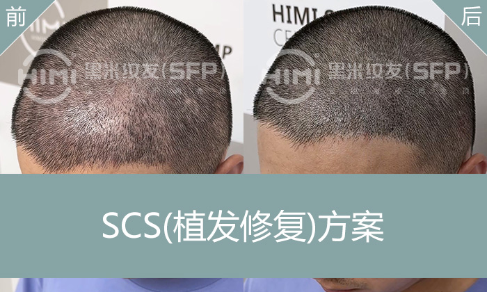 植发成活率低不满意？看北京杨先生如何用黑米纹发加密告别稀疏