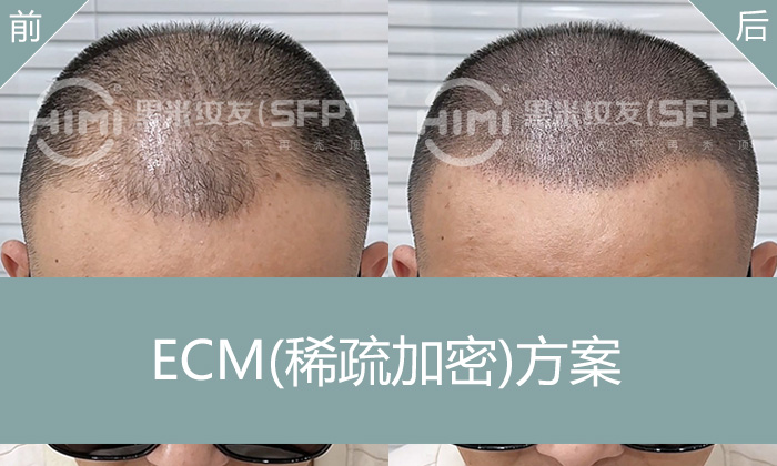 武汉脱发怎么办？周先生5年脱发，黑米纹发让头顶重获浓密