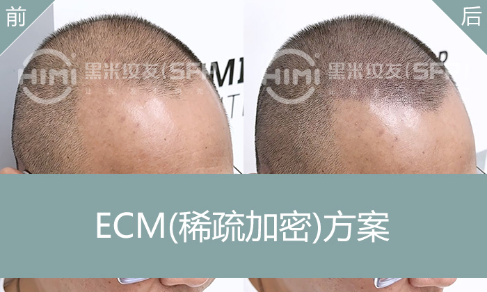 重庆刘先生头顶稀疏M型脱发10年纹发实录-头顶稀疏变浓密