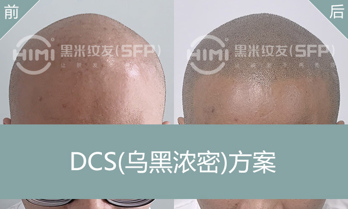 广州脂溢性脱发10年？黑米纹发打造浓密寸头！