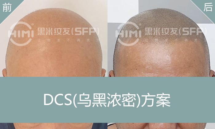 雄性激素脱发12年秃顶怎么办？黑米纹发变浓密寸头，改变形象