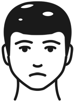 斑秃