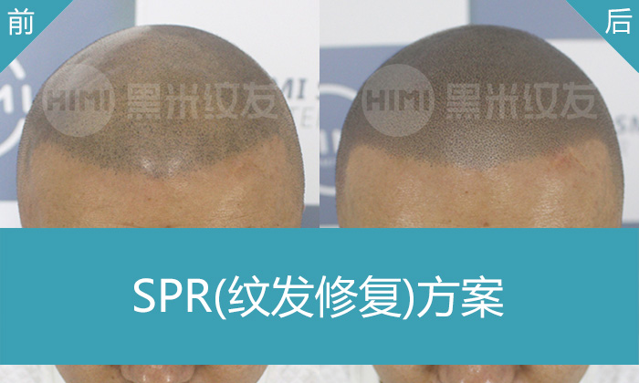SPR纹发修复