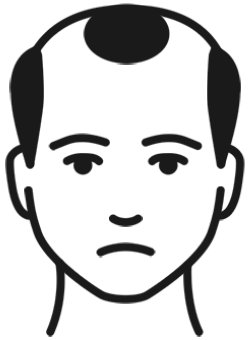 脂溢性脱发