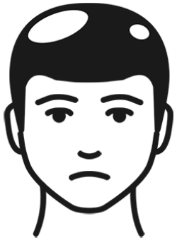 精神性脱发