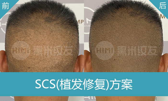 SCS植发修复