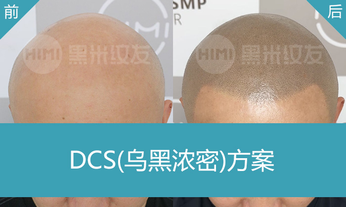 北京郭先生秃头多年！黑米纹发助其变浓密寸头，告别戴帽
