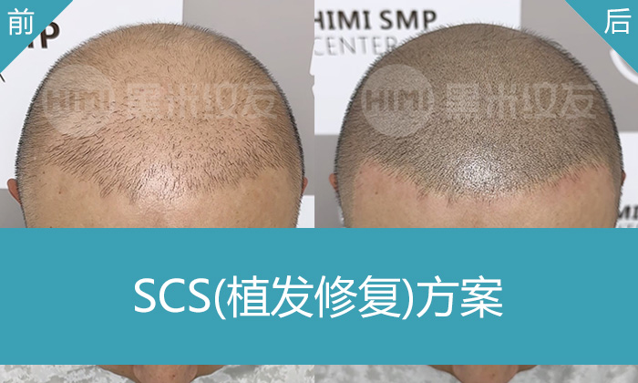 北京植发失败修复：王先生植发无效，黑米纹发让头顶变浓密