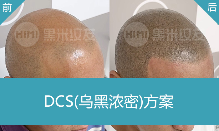 北京脱发者必看！地中海秃顶牛先生选黑米纹发，轻松拥有浓密寸头