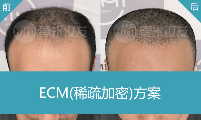 广州朱先生头顶稀疏？黑米纹发稀疏加密真实效果