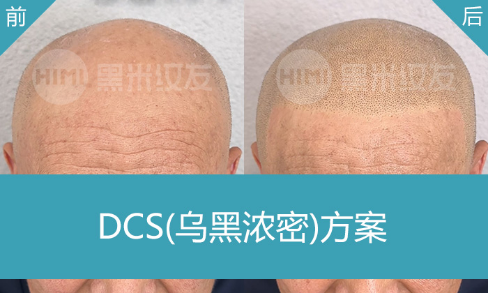 脱发10年无招？长春黑米纹发帮程先生告别秃顶，重现浓密头顶