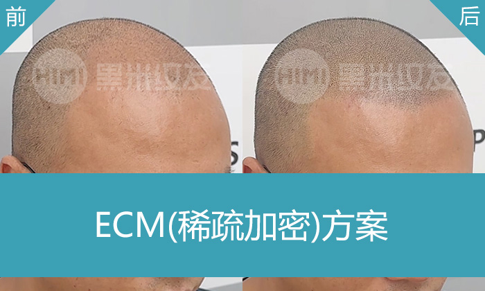 重庆倪先生8年脱发改善：黑米纹发解决M角后移/头顶稀疏，无需养护
