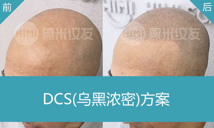 长春潘先生秃头纹发案例-黑米纹发让秃头变浓密寸头，年轻好几岁