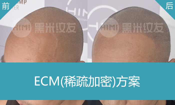 刘先生脱发10年，广州黑米纹发稀疏加密方案，纹发后头顶即刻浓密