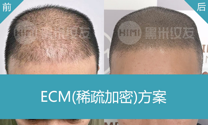 黑米纹发稀疏加密怎么样？广州黄先生8年脱发困扰终解决