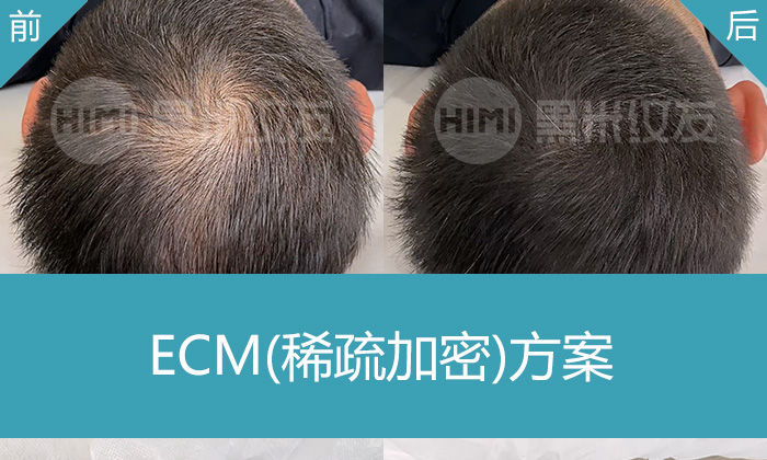 广州脱发7年？黑米纹发加密发旋，即刻告别稀疏显头皮